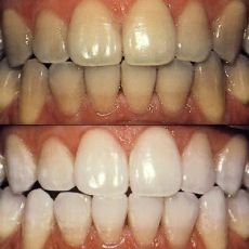 Последствия отбеливания зубов