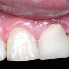 Реставрация зубов цена