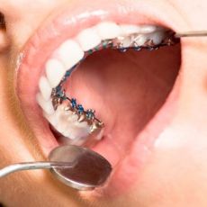 Привыкание к зубным протезам
